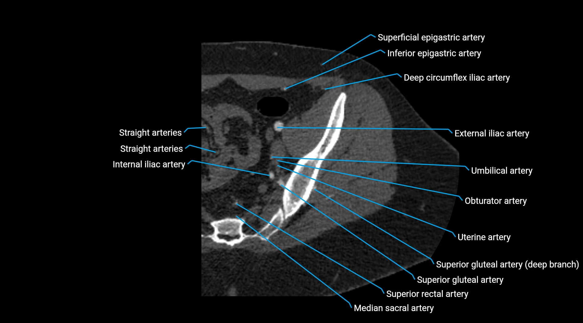 CTA lower limb cross sectional anatomy labelled image _33.webp